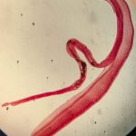 Woman's brain worm infection confirmed after eggs grow tails in lab test